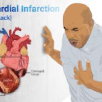 Heart attack wikimedia image